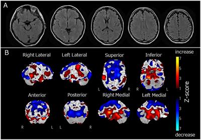 Case report: A case of anti-recoverin antibody-positive encephalitis exhibiting Cotard and Capgras delusions that was successfully treated with electroconvulsive therapy